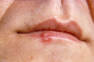 Cold sore on the lower lip of someone with white skin.