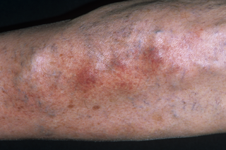 Close-up of phlebitis on a person's leg. The skin is lumpy due to varicose veins and there are several red areas. Image shown is on white skin.