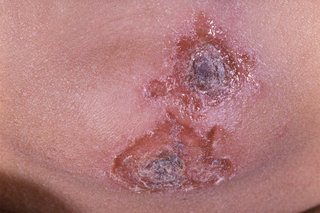 Impetigo on the chin. The patches are about 2cm wide, red and slightly orange, with darker scabs in the middle. Shown on brown skin.