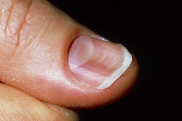 A close-up of a person’s thumbnail. There is a wide, curved groove along the middle of the nail, making it look spoon-shaped.