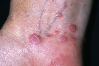 Lichen planus on the inside of the wrist of a person with white skin.