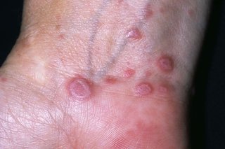 mayo clinic lichen planus