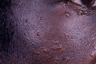 A close-up of the side of a person’s face showing raised spots near the eye (shown on dark brown skin).