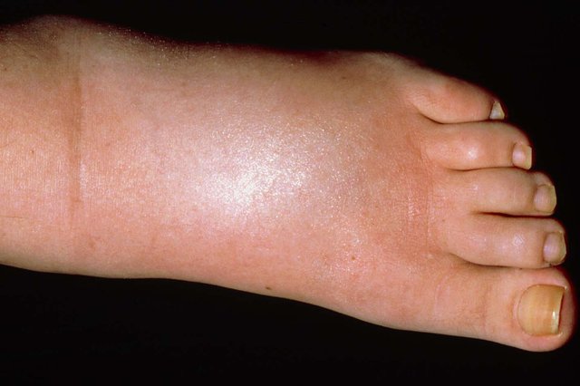 swollen top of foot causes