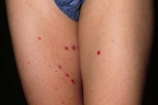 Henoch-Schönlein purpura on white skin. There are around 6 small red spots on a child's thighs.