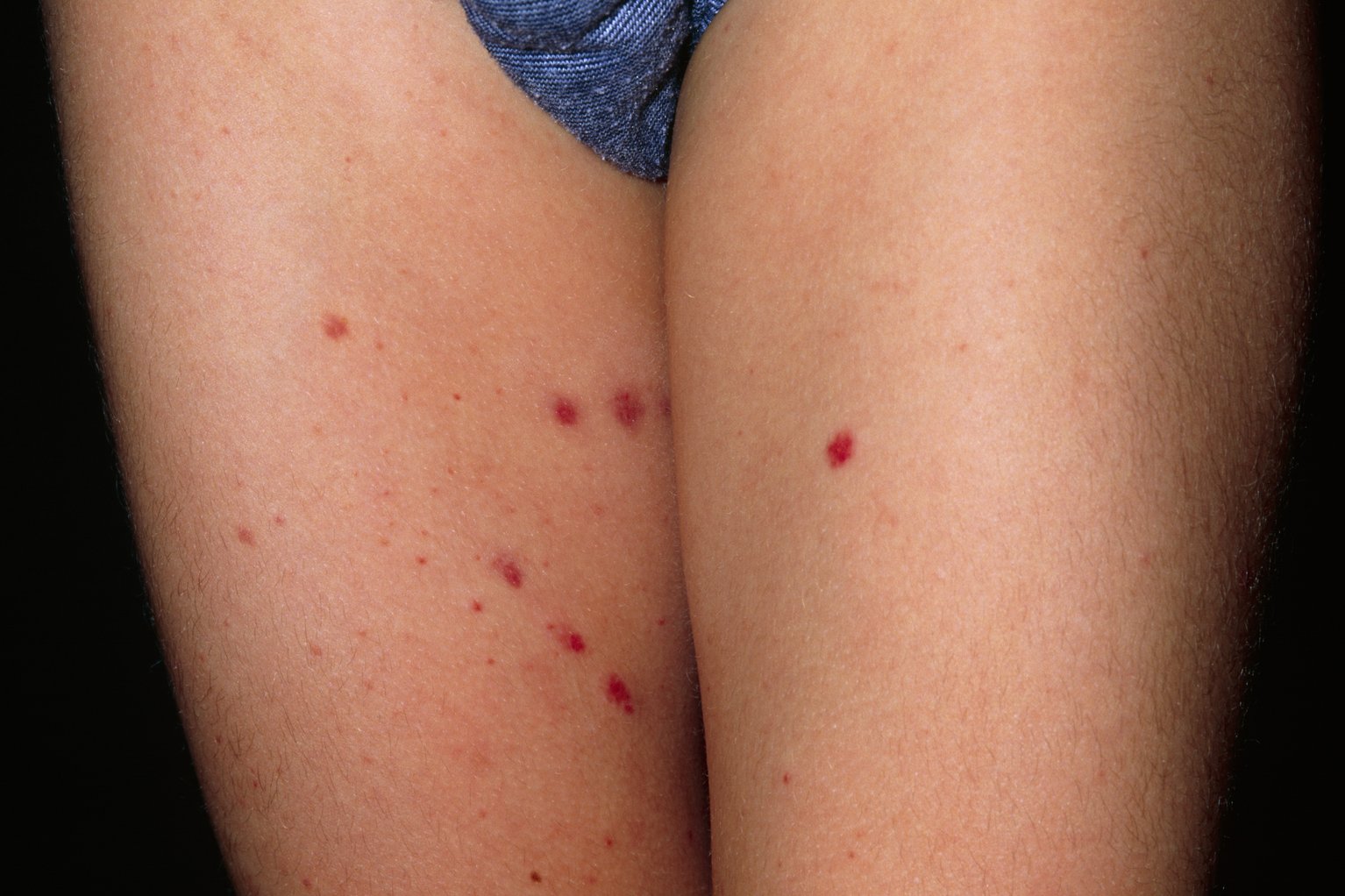 sporadic-red-bumps-on-body