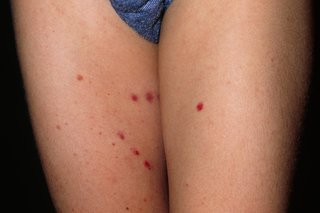 Henoch-Schönlein purpura on white skin. There are around 6 small red spots on a child's thighs.