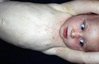 A young child lying on their side. Their forehead, face and upper body (down to their waist) is covered in pinkish-red spots.