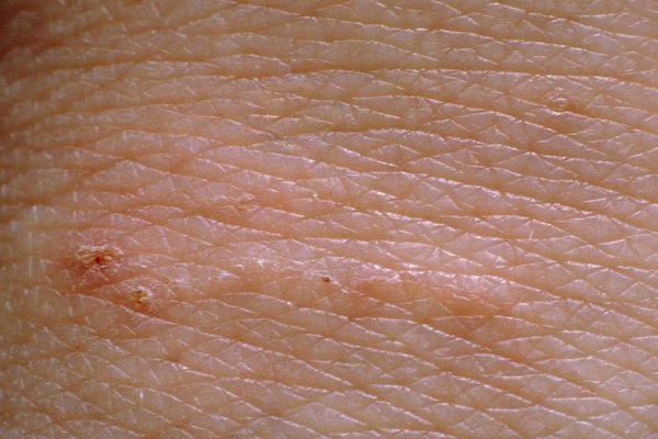 Scabies Rash on Black Skin: Symptoms and Treatment