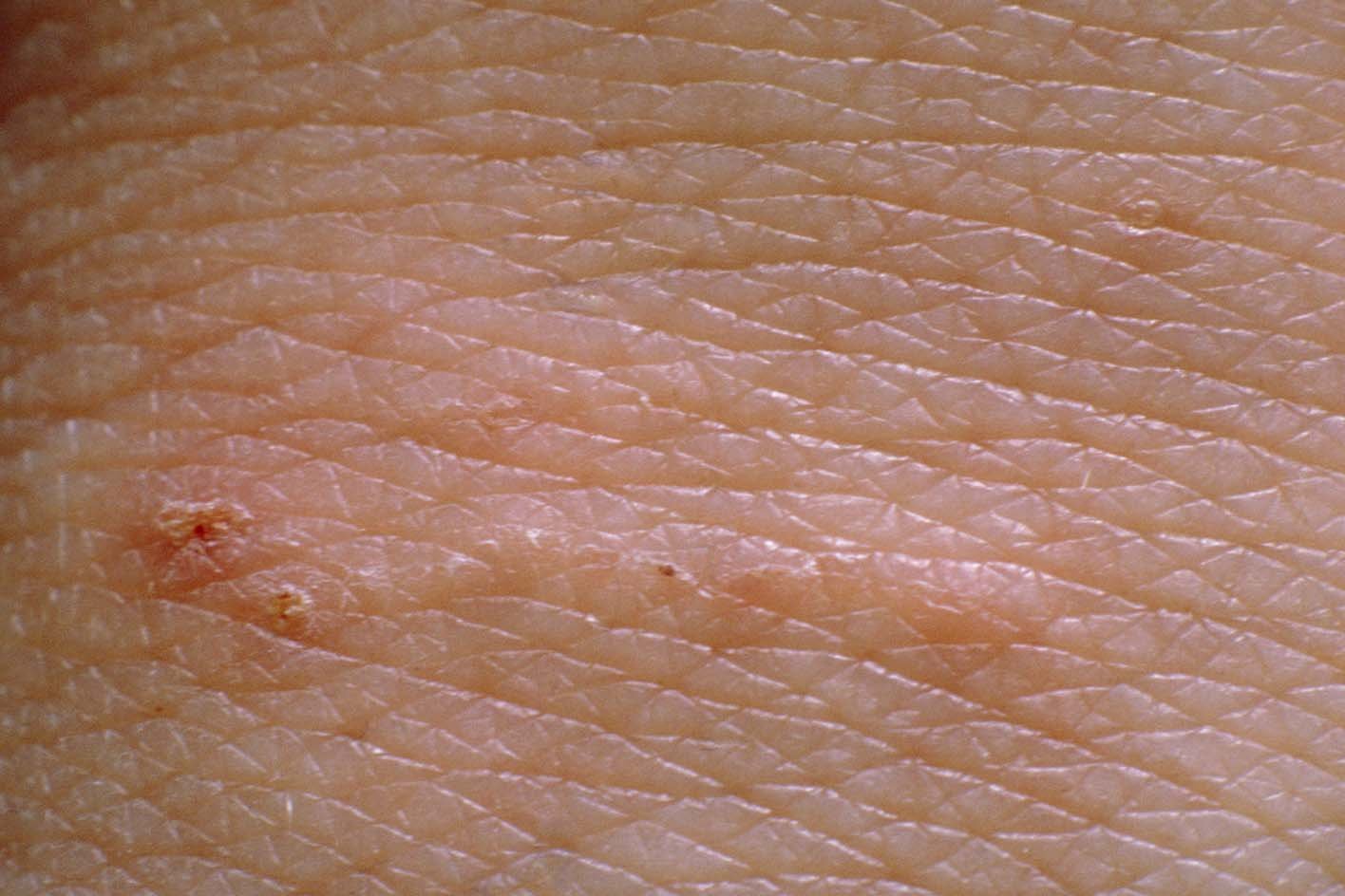 Scabies NHS Scabies NHS