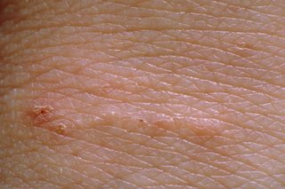 White skin with a line of tiny bumps  and a dot at one end.