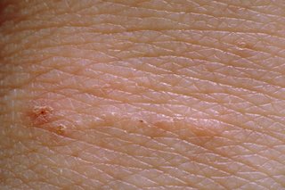 White skin with a line of tiny bumps and a dot at one end.