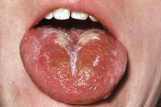 A swollen tongue with reddish orange surface and a white coating at the back and along the centre. Shown on white skin.