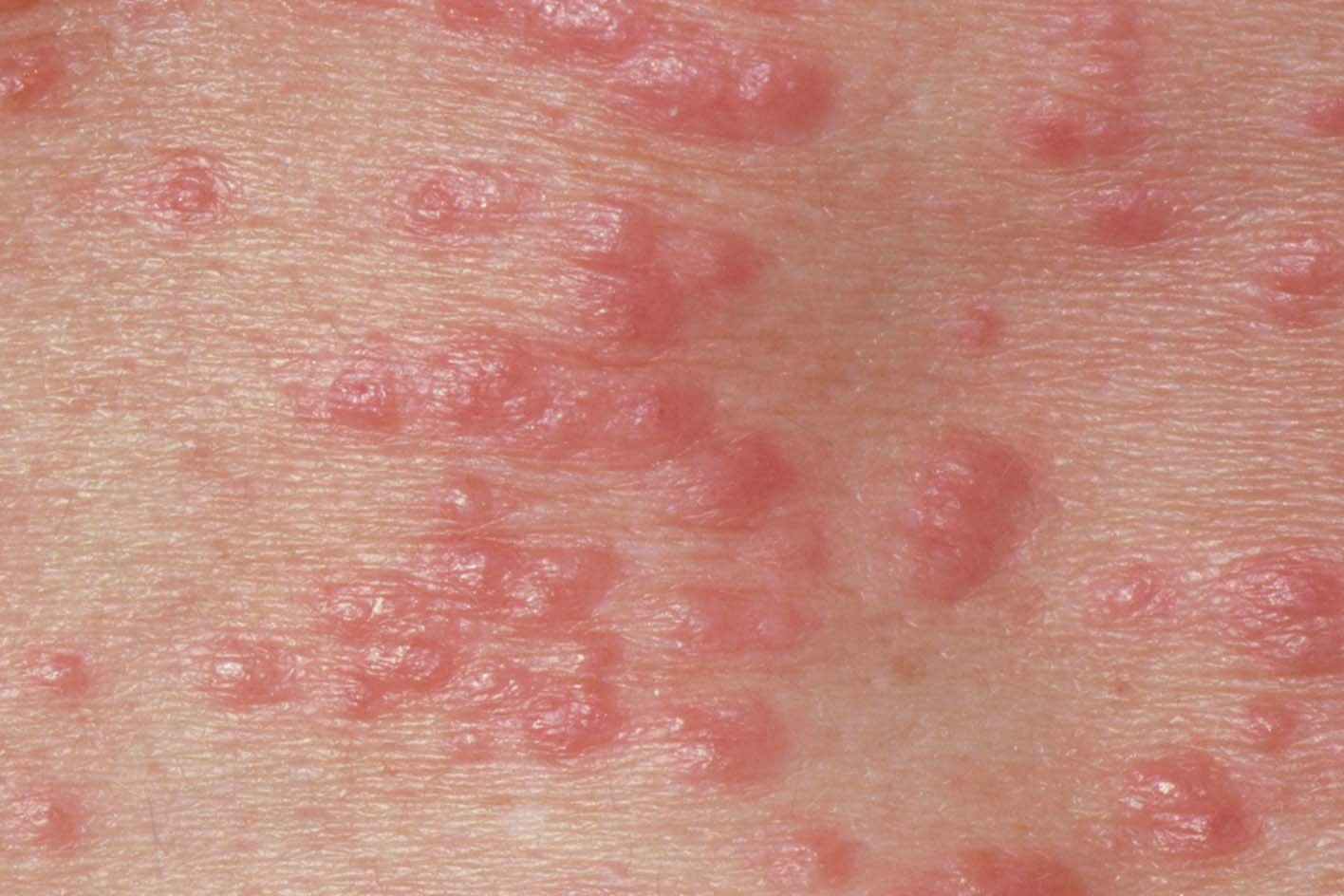 Scabies NHS Scabies NHS