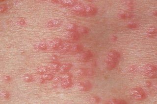 Red spots on the skin caused by scabies.