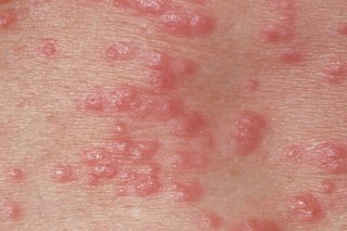 scabies burrows on legs