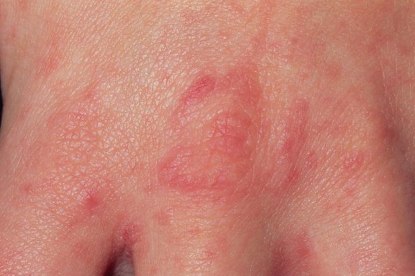 Scabies rash showing extensive involvement. Typical lesions present on