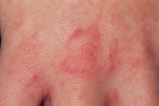 scabies rash on stomach