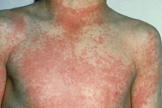 Red, spotty rash caused by scarlet fever on the chest, arms and neck of a child with white skin.