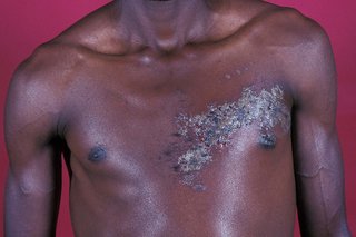 Shingles rash shown on dark brown skin. Blisters are grey and in a cluster on 1 side of a person’s chest.