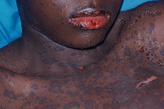 Stevens-Johnson syndrome rash on the face and chest of a person with black skin. A dark, blotchy rash covers the skin and lips and some skin is peeling.