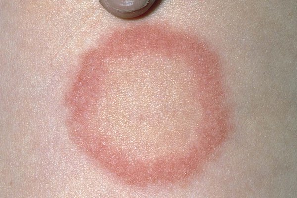 Ringworm: Signs and symptoms