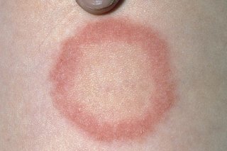 A large, circular rash on a person with white skin. There is a red outer ring and a paler inner circle that is slightly darker than their normal skin tone.