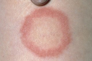 ringworm on human skin legs