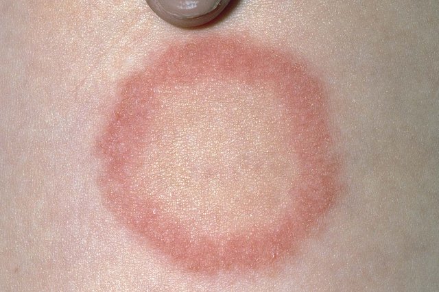 Ringworm on Tattoo: When to See a Doctor - wide 7