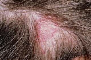 Close-up of the top of a person’s head. They have brown hair and there is a patch of dark pink, scaly skin (a ringworm rash) on their scalp.