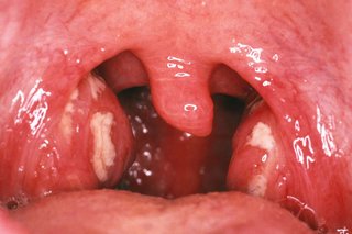 White patches on swollen tonsils at the sides of the throat.