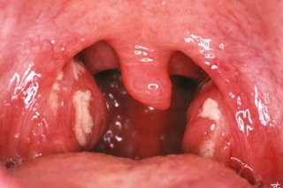 White patches on tonsils in the back of the mouth.