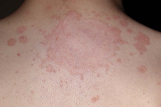 A large ringworm rash on white skin