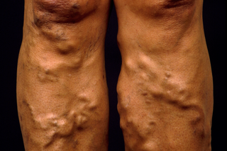 The lower legs of a person with brown skin. Both legs have varicose veins which look like raised, twisted cords and lumps under the skin.