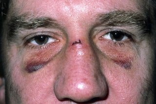 A person's face with bruising under both their eyes and cut on their nose.