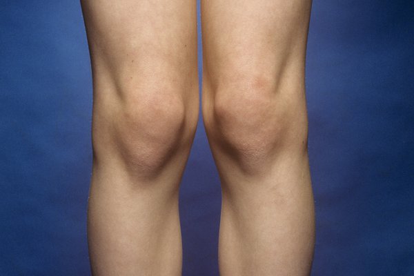 Picture of knock knees