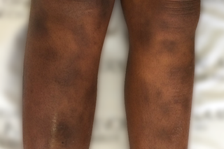 A person's lower legs. They have medium brown skin and there are some darker patches on their shins that look like bruises.