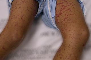 Henoch-Schönlein purpura on medium brown skin. There's lots of small, purple-red spots and patches on a child's legs.