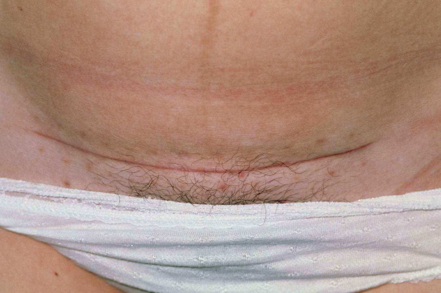 Picture of a caesarean section scar. 