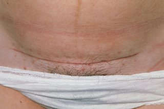 Picture of a caesarean section scar