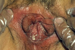 A vagina with white discharge caused by thrush. Shown on brown skin.