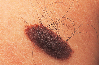 A harmless, raised, dark-coloured mole with hair growing from it on white skin