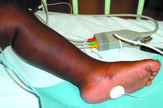 Blotchy meningitis rash on the leg and foot of a child. Shown on black skin.