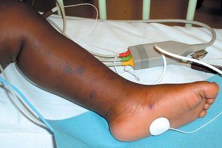 Blotchy meningitis rash on the leg and foot of a child. Shown on black skin.