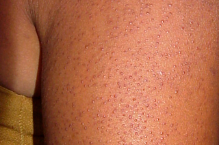 Small bumps close together on the back of the arm, shown on brown skin. The bumps are the same colour as the skin.