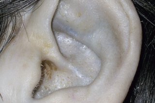 Aar affected by alkaptonuria, with yellow and blue-black discolouration of the cartilage