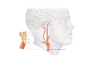 An illustration of the side of a head and neck with a red tube (this is the carotid artery) running up from the neck and splitting into 2 before going into the brain.