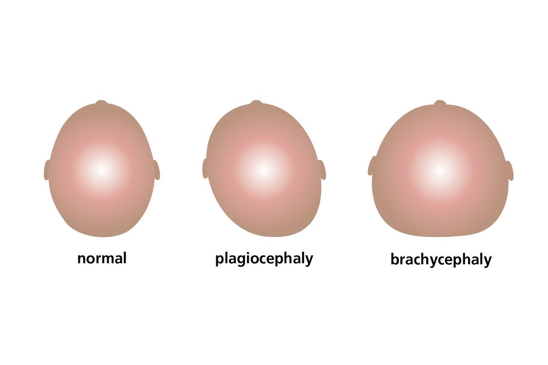 Plagiocephaly and brachycephaly (flat head syndrome) NHS
