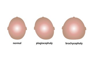Illustration of flattened heads. A plagiocephaly head is flat on one side. The back of a brachycephaly head is wide and flat.