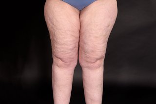 A person with white skin and enlarged thighs with dimpled skin caused by lipoedema.